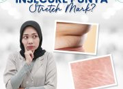Stretch Mark Jadi Masalah Sering Dihadapi Wanita, Apa Itu?