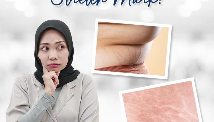 Stretch Mark Jadi Masalah Sering Dihadapi Wanita, Apa Itu?