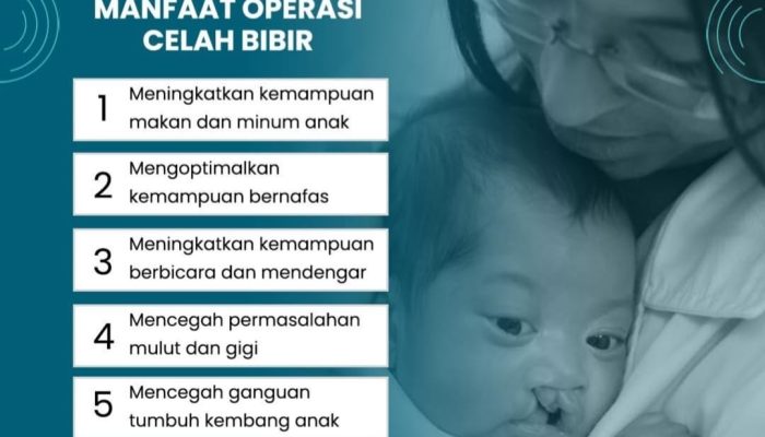 Sumbing Bawaan? Ini Manfaat Operasi Celah Bibir