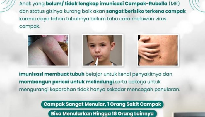 Kasus Campak Meningkat, RSUD Pandega Pangandaran Imbau Orang Tua Tingkatkan Kewaspadaan